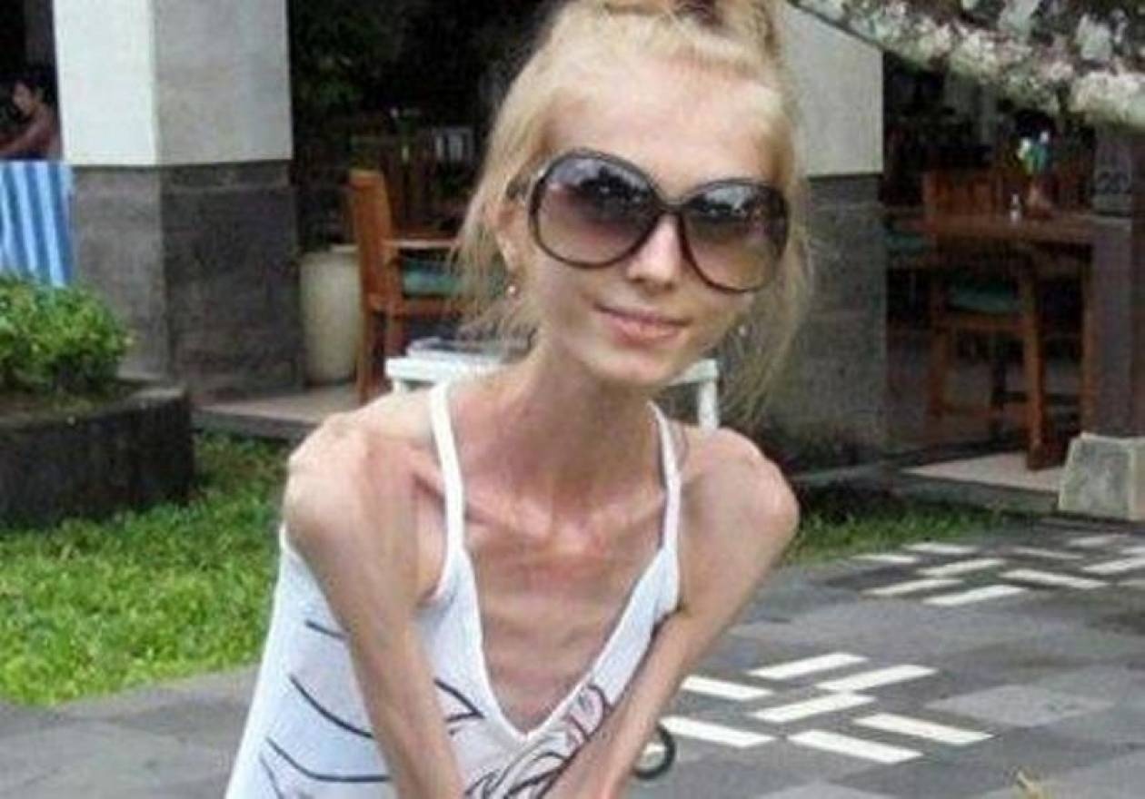 Σοκ: Κοπέλα 20 ετών ζυγίζει 20 κιλά!
