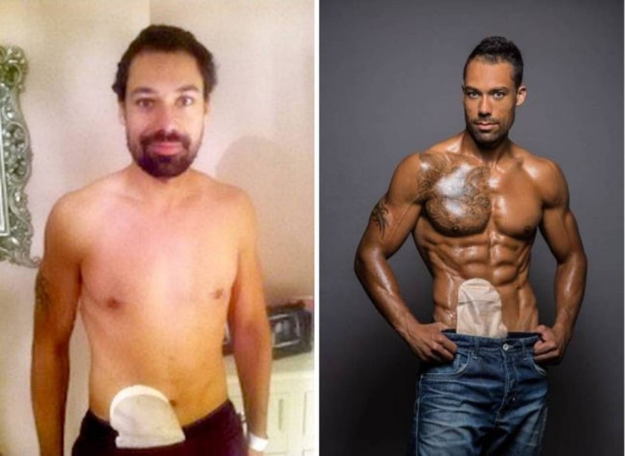 Έχει κολοστομία αλλά έγινε μοντέλο! (pics)