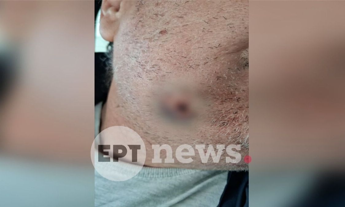 Αιγάλεω: Άγρια ληστεία σε βάρος οδηγού ταξί - Τον μαχαίρωσαν και του έκλεψαν το αυτοκίνητο