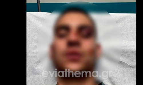 Χαλκίδα: 18χρονος έστειλε στο νοσοκομείο με κατάγματα 19χρονο για ένα like