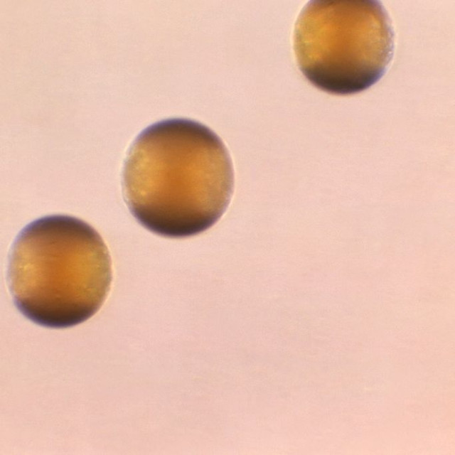 Μηνιγγίτιδα: Σκοτώνει πάνω από 250.000 ανθρώπους παγκοσμίως κάθε χρόνο