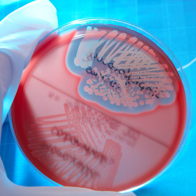 Λοίμωξη από σταφυλόκοκκο: Πρώιμα σημάδια - Τι να κάνετε αμέσως