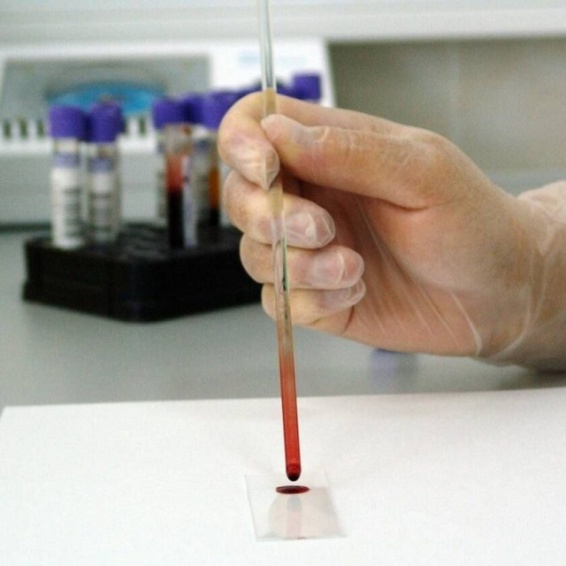 Χαμόγελα από μεταμόσχευση επεξεργασμένων βλαστοκυττάρων σε επιθετικούς καρκίνους αίματος