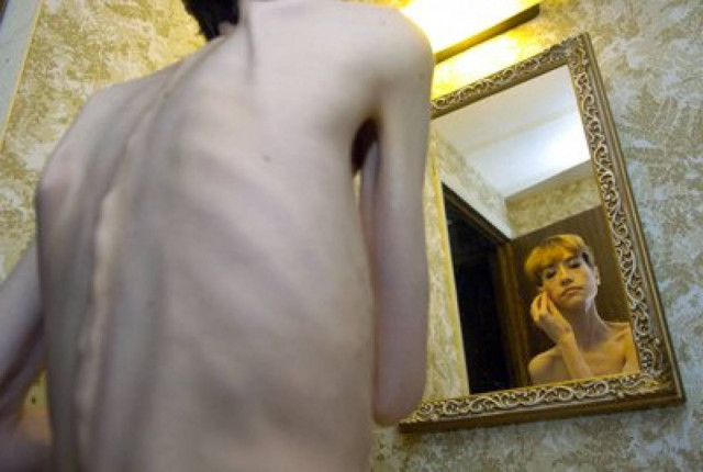 Θύμα νευρικής ανορεξίας 24χρονη φοιτήτρια