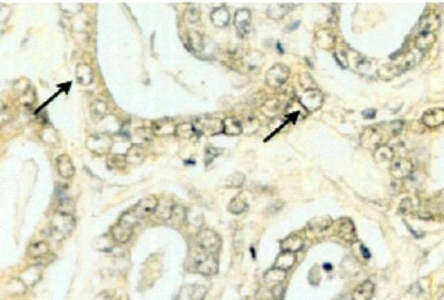 15η Σεπτεμβρίου: Παγκόσμια Ημέρα κατά του Καρκίνου του Προστάτη