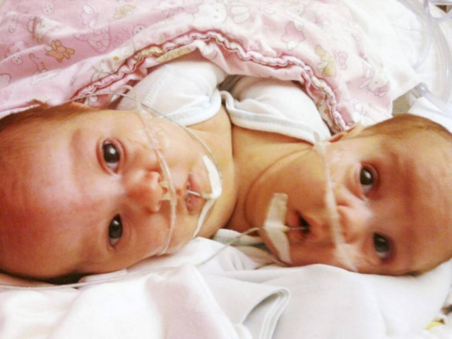 Βρετανοί διαχώρισαν σιαμαίες