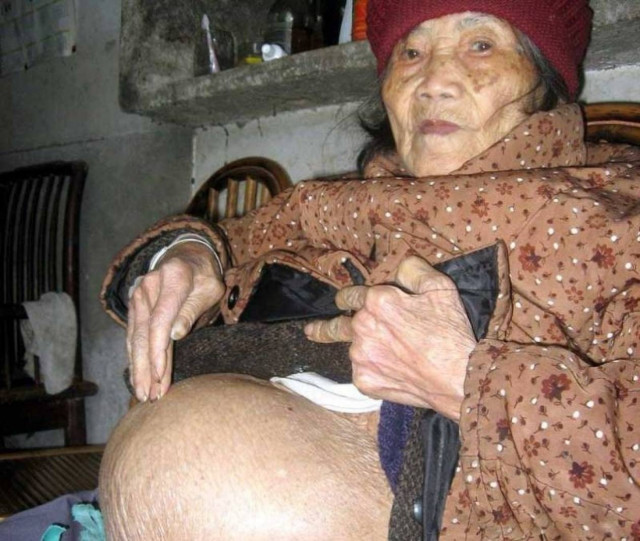 Εγκυμονούσε νεκρό μωρό 63 χρόνια