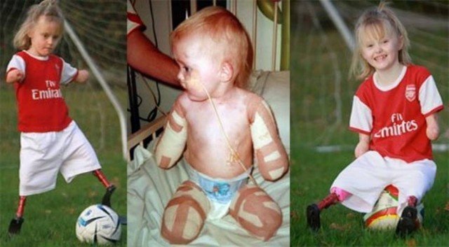 Επτάχρονη παίζει ποδόσφαιρο με τεχνητά μέλη