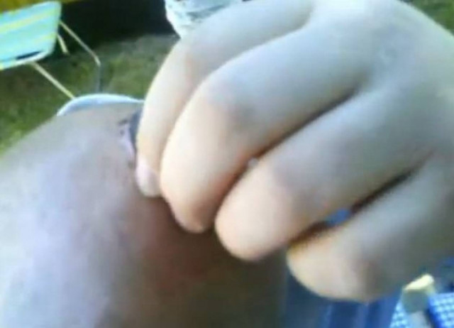 Ζει με μια τρύπα στο κεφάλι