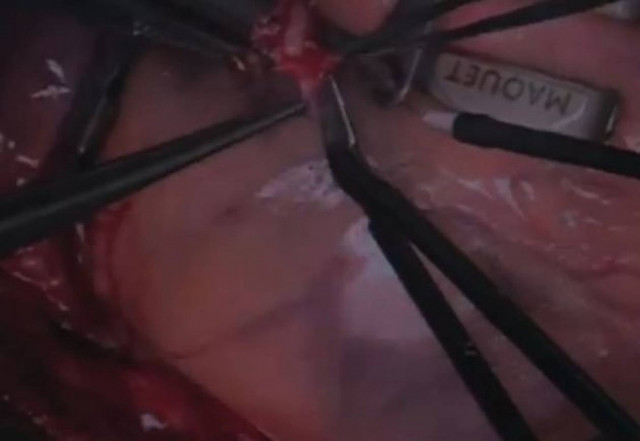 Εγχείρηση ανοικτής καρδιάς μεταδόθηκε LIVE στο Twitter