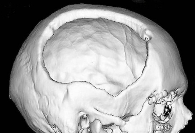 Ζει με μισό κρανίο