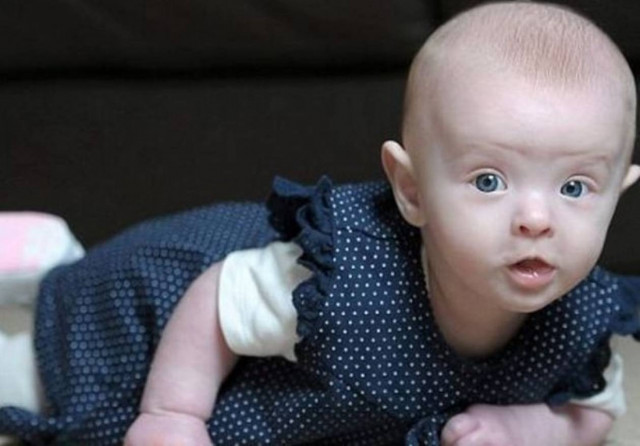 Μωρό γεννήθηκε «στεγνό» από αίμα και επέζησε