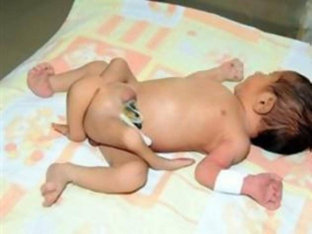 Προβληματισμός για την εγχείρηση του βρέφους με τα έξι πόδια