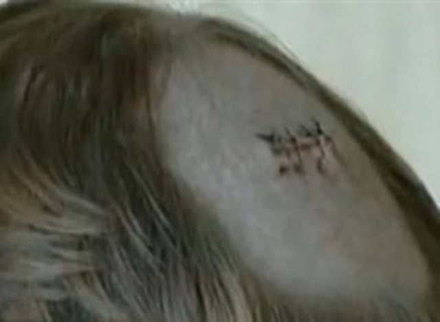 Έζησε για 94 χρόνια με μία σφαίρα στο κεφάλι