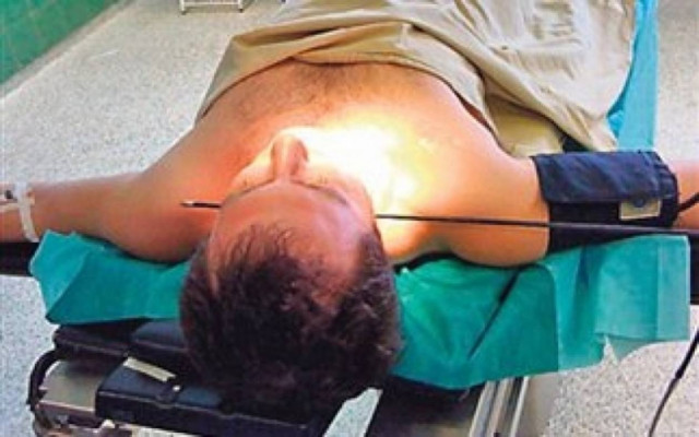 Καρφώθηκε βέλος στο λαιμό του και σώθηκε! (βίντεο)