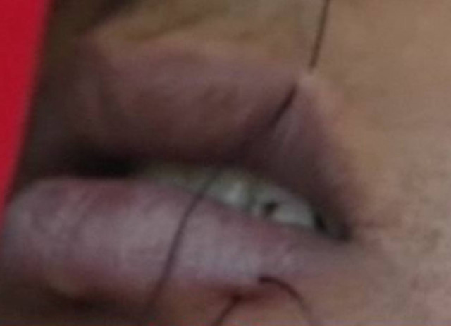 Έραψαν τα χείλη τους σε ένδειξη διαμαρτυρίας