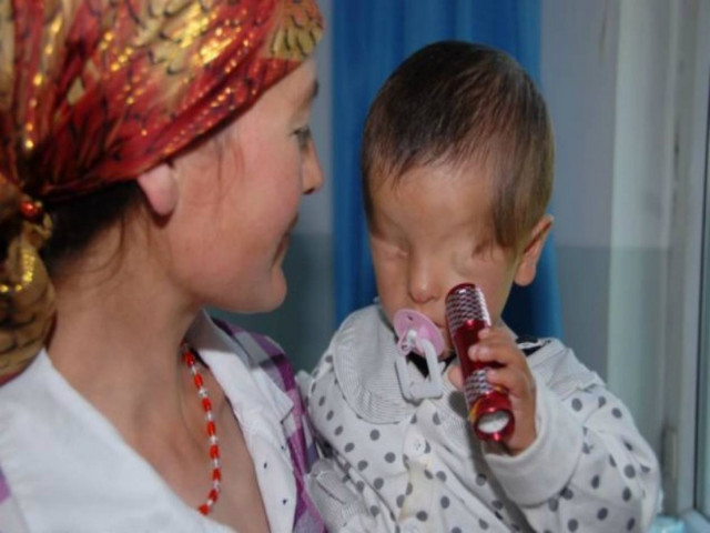 Παγκόσμια συγκίνηση για το αγοράκι που γεννήθηκε χωρίς μάτια