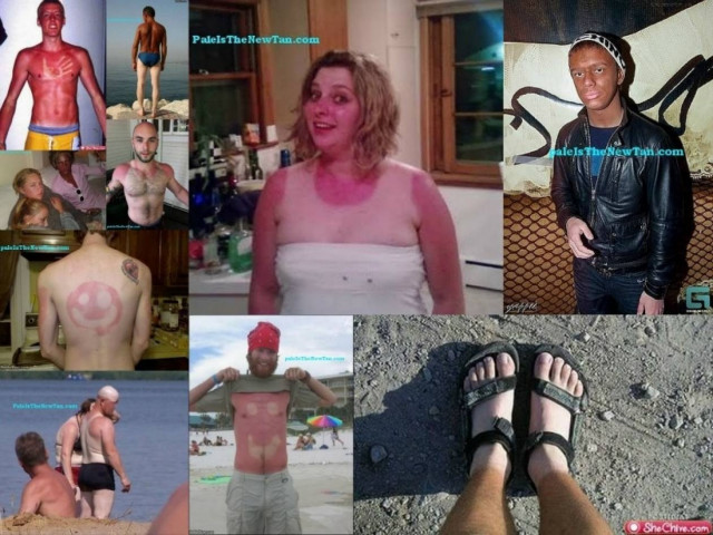 Τα χειρότερα καλοκαιρινά μαυρίσματα που έχετε δει! (pics)