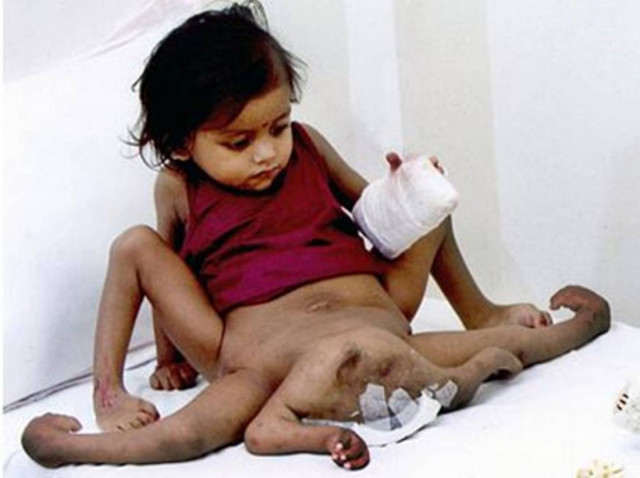 Ινδία: Βρέφος γεννήθηκε με οκτώ άκρα!