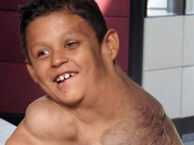 Διάσωση παιδιού με όγκο στο λαιμό