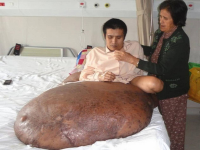 Οι γιατροί κέρδισαν τον αγώνα για την αφαίρεση όγκου 89 κιλών