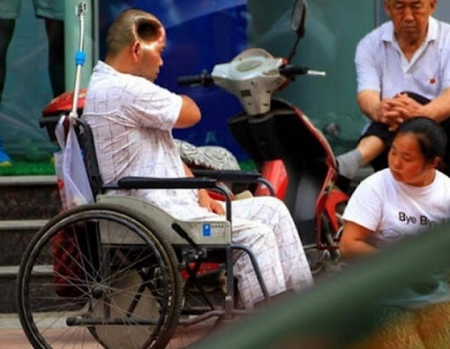 ΔΕΙΤΕ: Σοκάρει ο Κινέζος με την τρύπα στο κεφάλι!!!