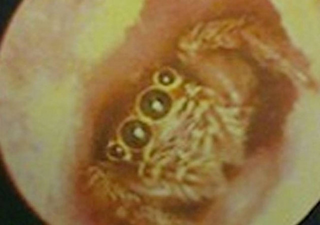 Αράχνη μπήκε στο αυτί γυναίκας