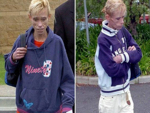 Τραγικό τέλος για τις ανορεκτικές δίδυμες