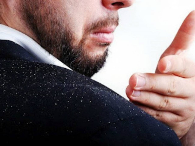 Πιτυρίδα τέλος σε 5 βήματα!