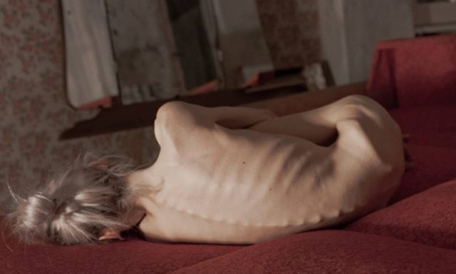 Η μάστιγα της νευρικής ανορεξίας - Ποια είναι τα συμπτώματα και πώς αντιμετωπίζεται