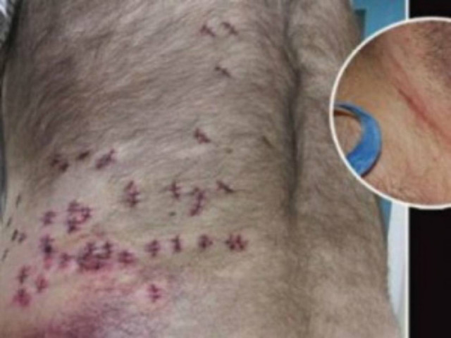 Τον μαχαίρωσαν 38 φορές αλλά σώθηκε λόγω... πάχους!