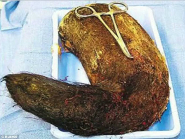 Αηδιαστικό: Δεν θα πιστεύετε τι έβγαλαν από το στομάχι της οι γιατροί