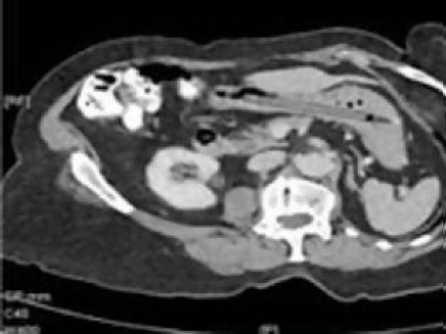 Δεν θα πιστεύετε τι είχε μια γυναίκα για 25 χρόνια στο στομάχι της