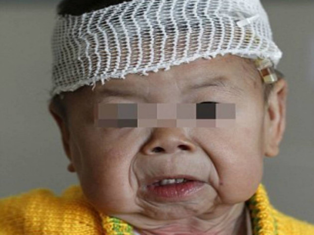 Κοριτσάκι ενός έτους παγιδευμένο σε σώμα ηλικιωμένης