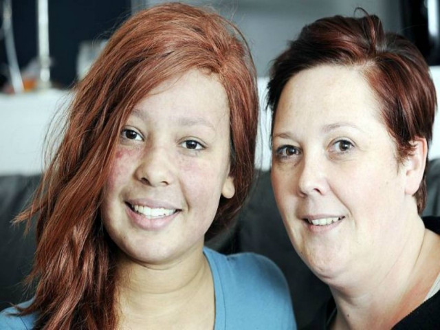 15χρονη καλλονή παθαίνει εγκαύματα ακόμη κι από… λάμπες