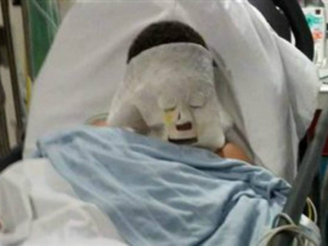 Βεγγαλικό διέλυσε το πρόσωπο 10χρονου - Σε κρίσιμη κατάσταση ο μικρός