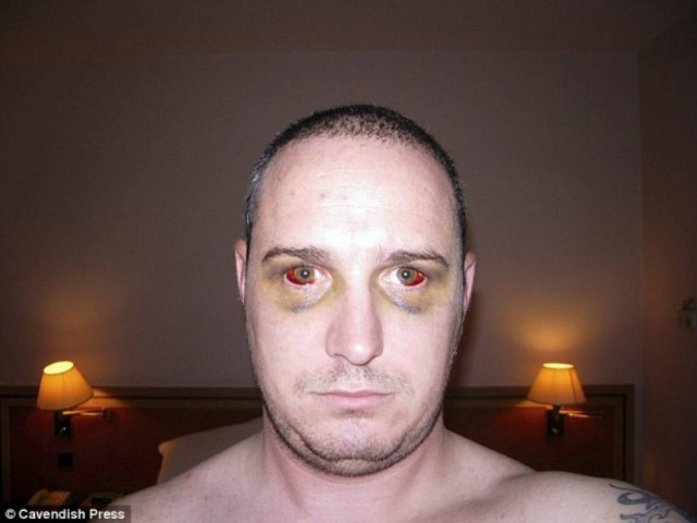 Εικόνα-σοκ: Το πρόσωπο ενός σωματοφύλακα μετά από βομβιστική επίθεση!