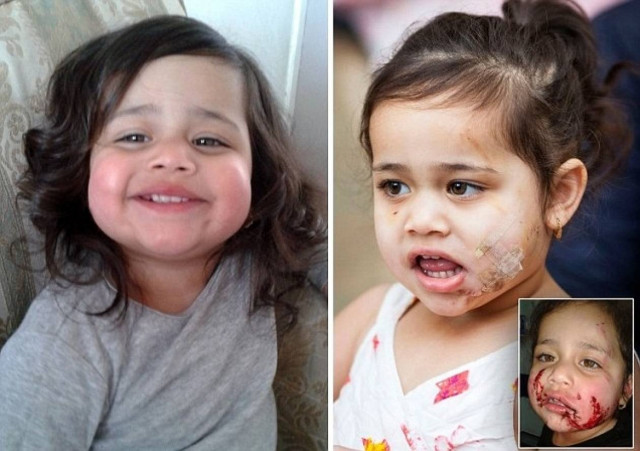 Σκληρές εικόνες: Σκύλος επιτέθηκε σε 2χρονη την ώρα που εκείνη έπαιζε