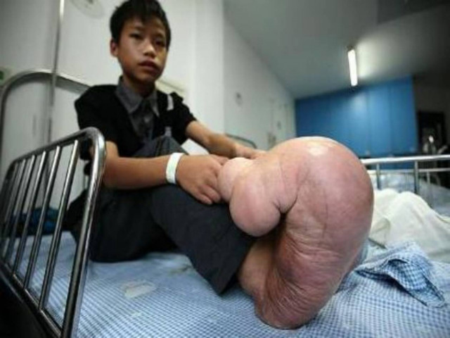 Βίντεο: Τα πόδια του είχαν το μέγεθος καρπουζιού!