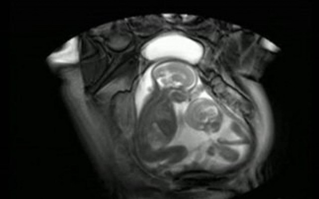 Βίντεο: Δίδυμα τσακώνονται μέσα στη μήτρα