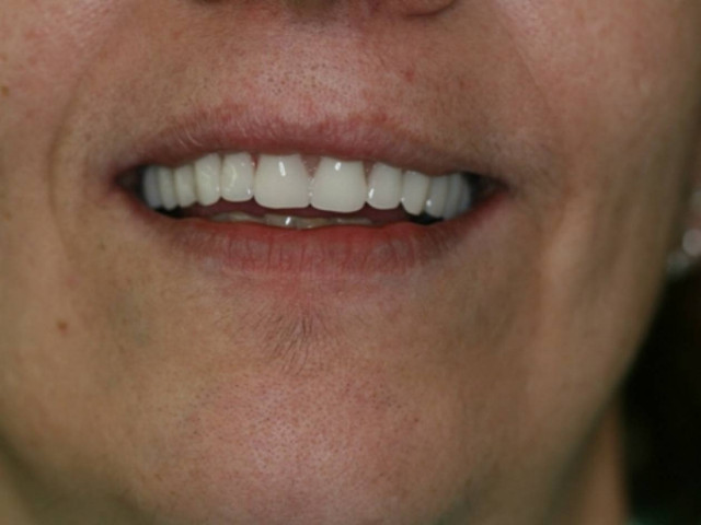 Οδοντοστοιχία... 1800 ευρώ στην Ηγουμενίτσα και 250 στη Βουλγαρία!