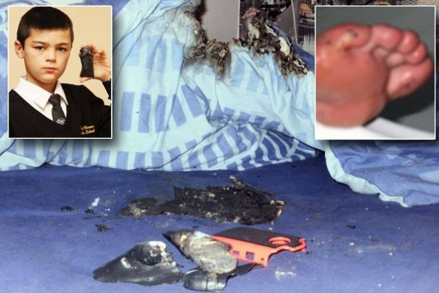 Κινητό εξερράγη και προκάλεσε σοβαρά εγκαύματα σε 11χρονο