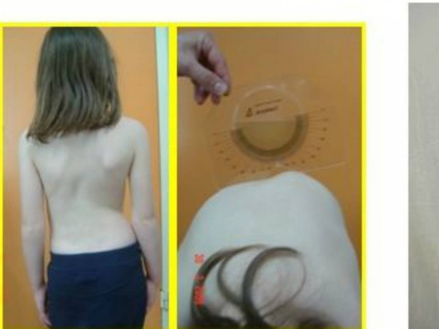 Σκολίωση: Συχνή στα κορίτσια. Αναγνωρίστε την και λύστε το πρόβλημα