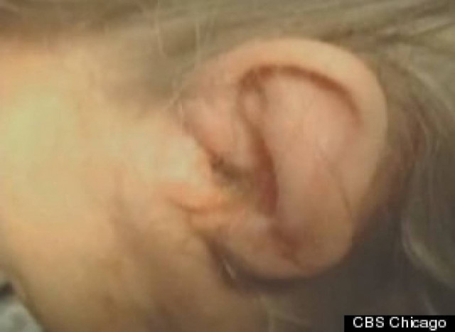 ΦΡΙΚΗ: Της αφαίρεσαν από το αυτί 57...