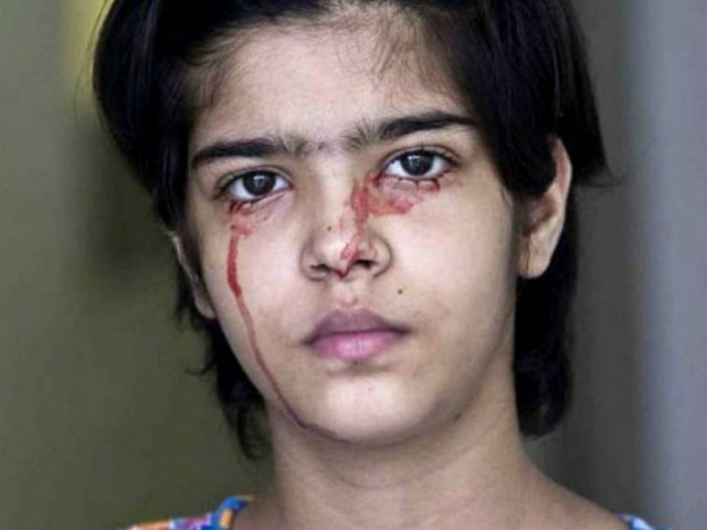 ΣΟΚΑΡΙΣΤΙΚΟ: Τρεις άνθρωποι που βγάζουν δάκρυα από αίμα