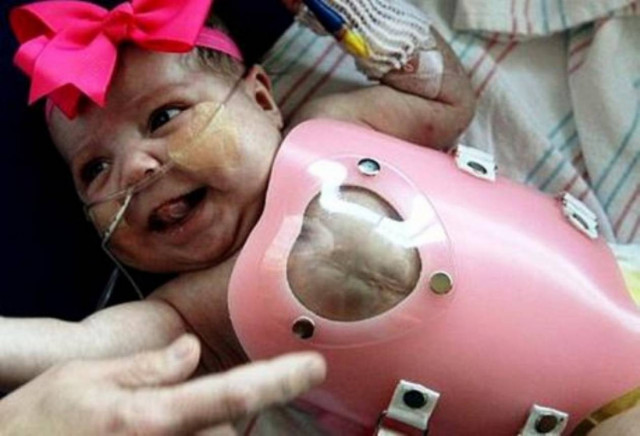 Συγκλονιστικό: Βρέφος έζησε με την καρδιά έξω από το στήθος