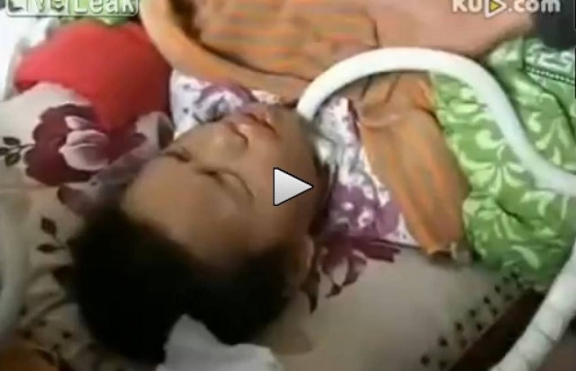 Έφτιαξαν αυτοσχέδιο αναπνευστικό μηχάνημα για να ζήσει ο γιος τους