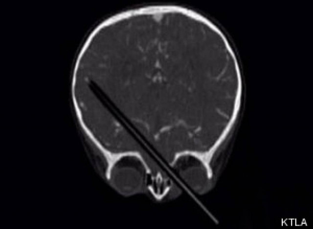 ΦΡΙΚΗ: Μολύβι καρφώθηκε στον εγκέφαλο ενός παιδιού 2 ετών