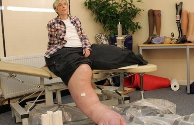 Απίστευτο: Το ένα της πόδι μόνο ζυγίζει... 107 κιλά (pics)