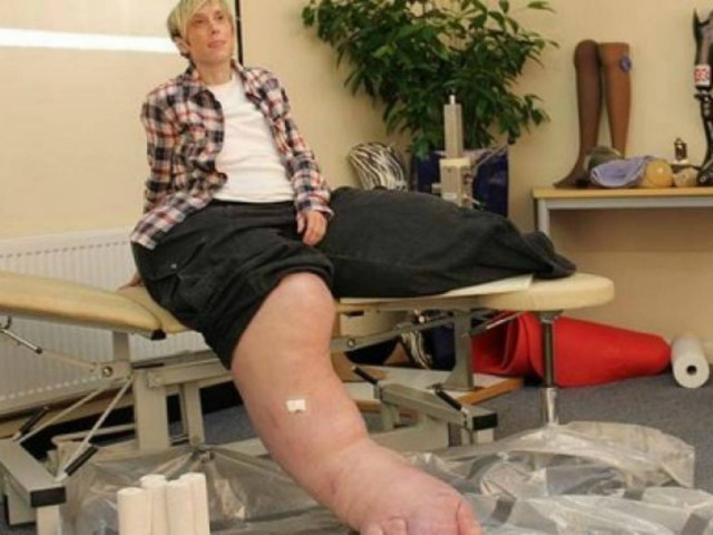 Απίστευτο: Το ένα της πόδι μόνο ζυγίζει... 107 κιλά